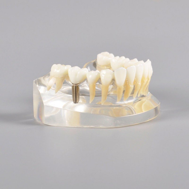 Implant Model Mandibular with Natural Color Teeth
