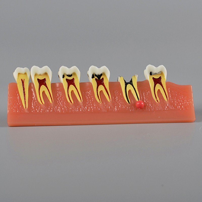 Caries Illustration Model - Image 2