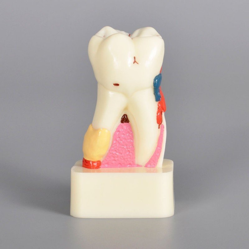 4 X Pathology model with progress of caries - Image 5