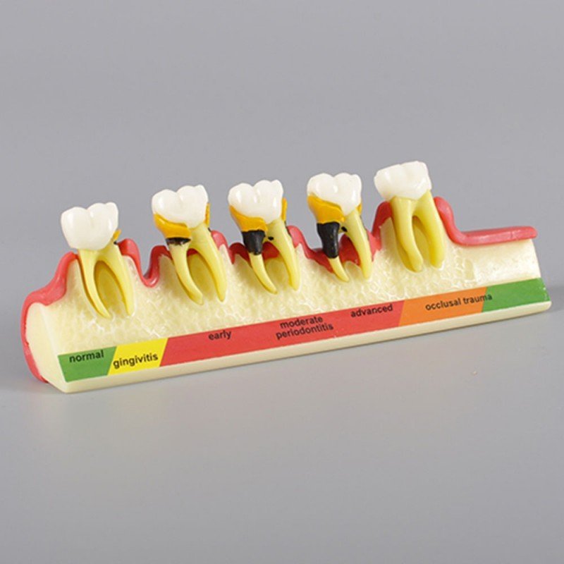 PERIODONTAL DISEASE MODEL - Image 2