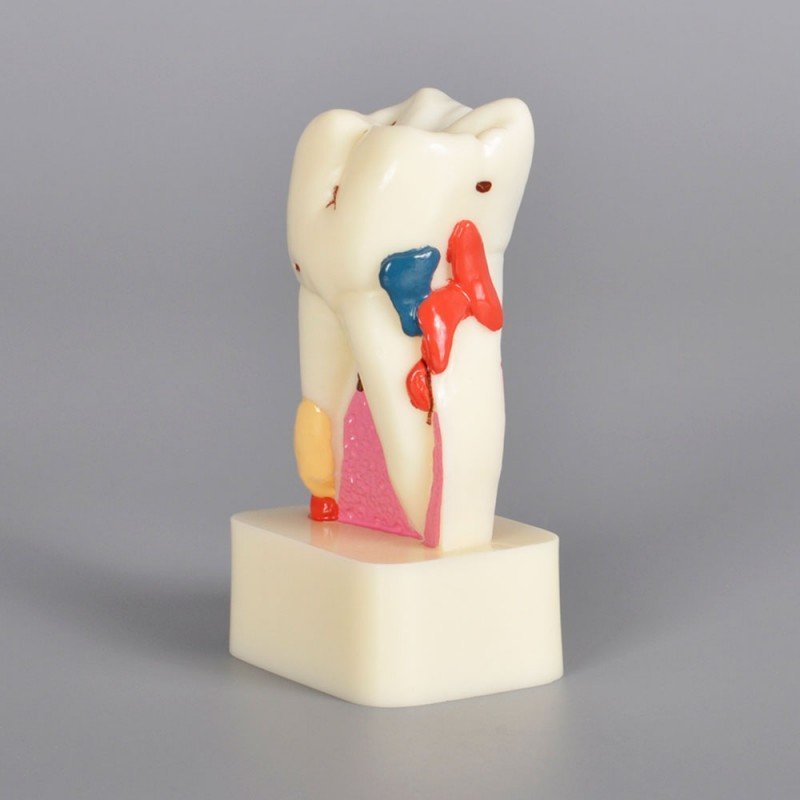 4 X Pathology model with progress of caries