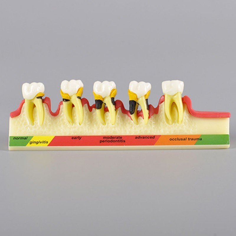 PERIODONTAL DISEASE MODEL