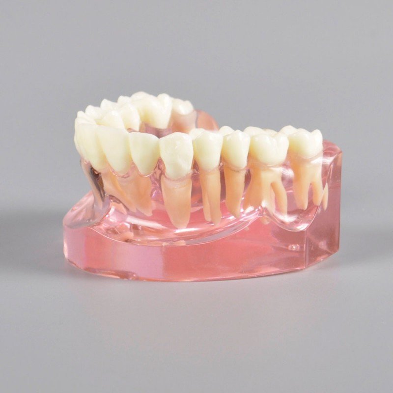 Implant model with ceramic bridge implant bridge - Image 3