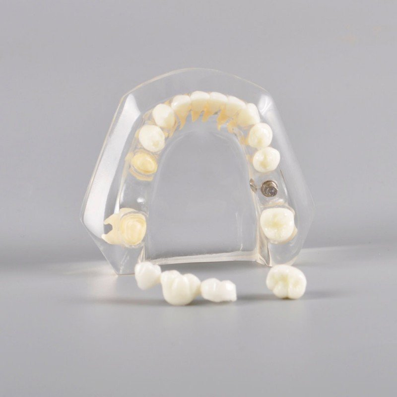 Implant Model Mandibular with Natural Color Teeth - Image 4