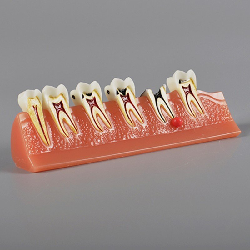 Caries Illustration Model - Image 4