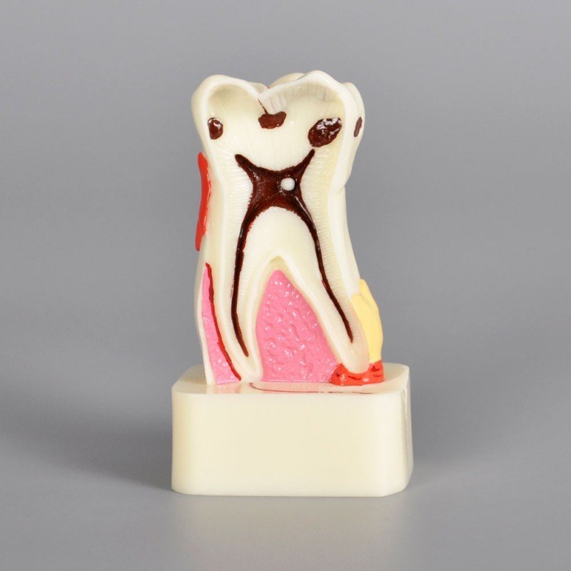4 X Pathology model with progress of caries - Image 3