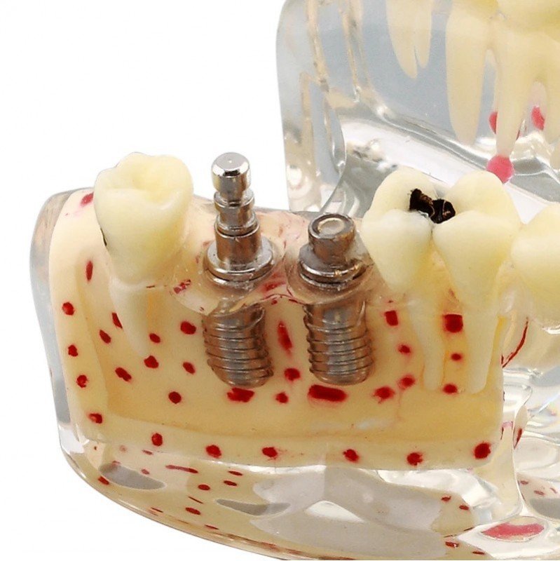 Implant Model with Caries and Root Fracture - Image 4