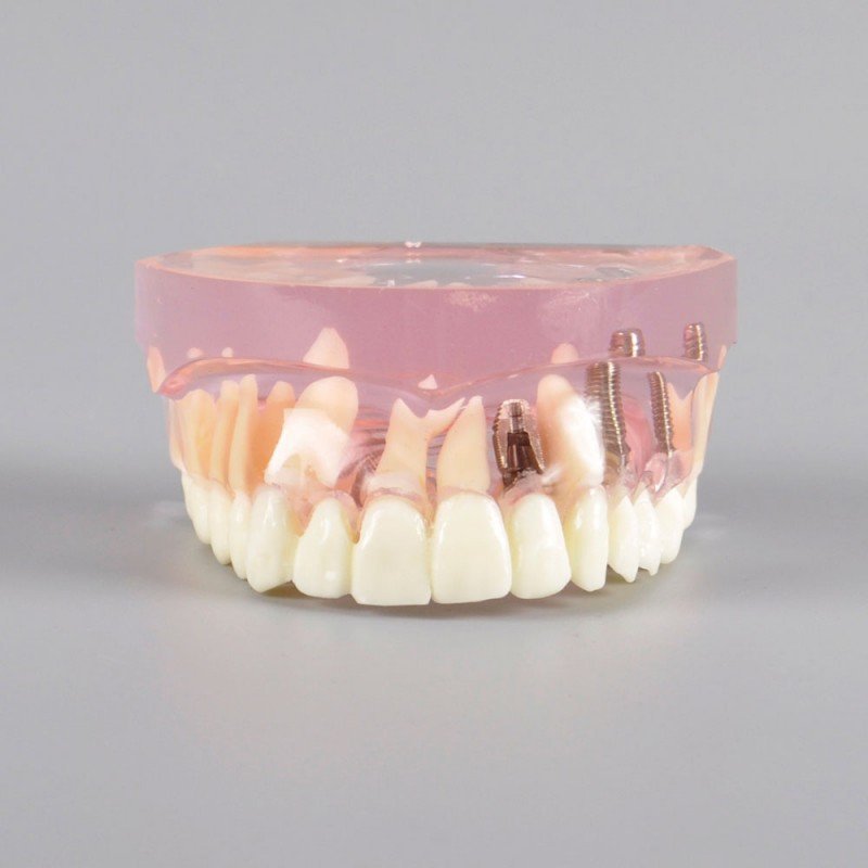 Implant model with ceramic bridge implant bridge - Image 2