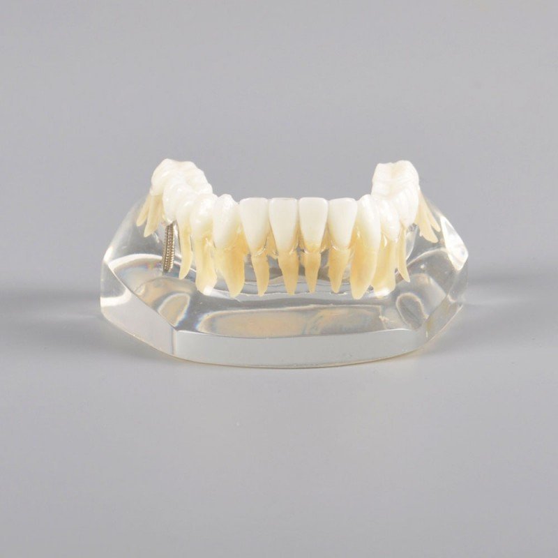 Implant Model Mandibular with Natural Color Teeth - Image 3