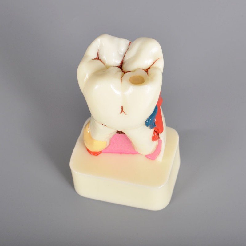 4 X Pathology model with progress of caries - Image 2