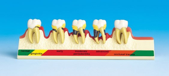PERIODONTAL DISEASE MODEL - Image 4