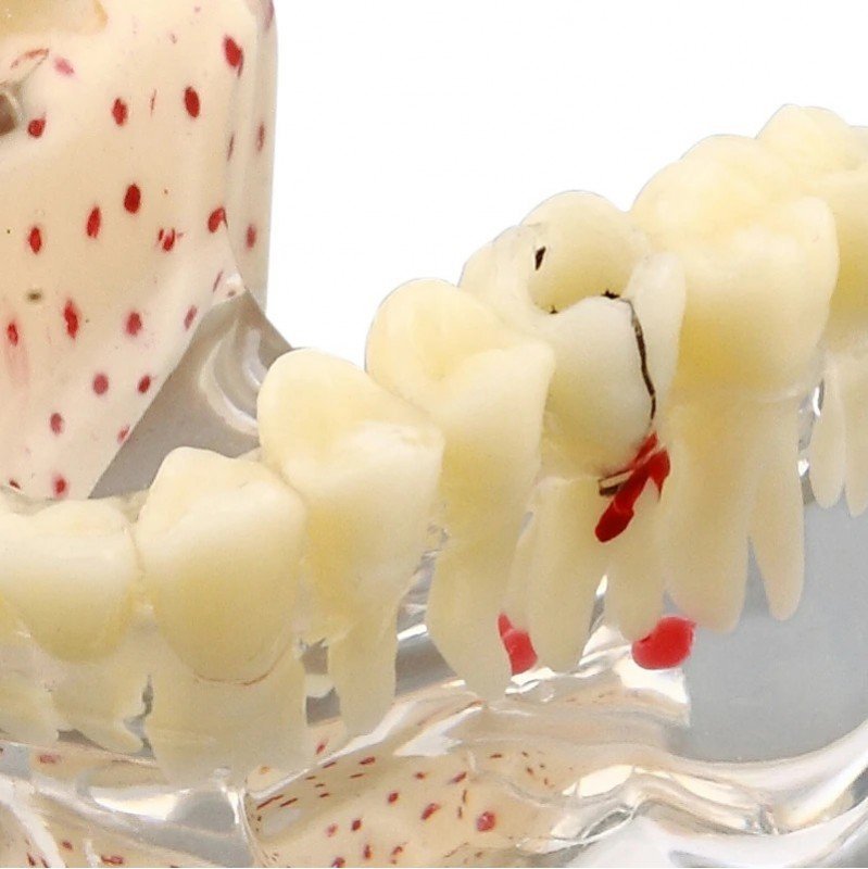 Implant Model with Caries and Root Fracture - Image 3