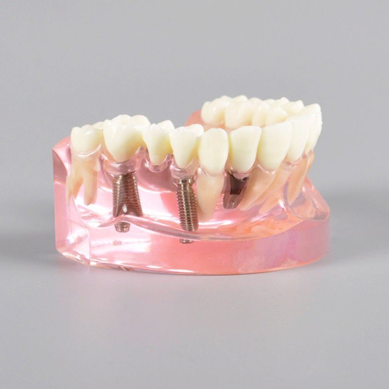 Implant model with ceramic bridge implant bridge