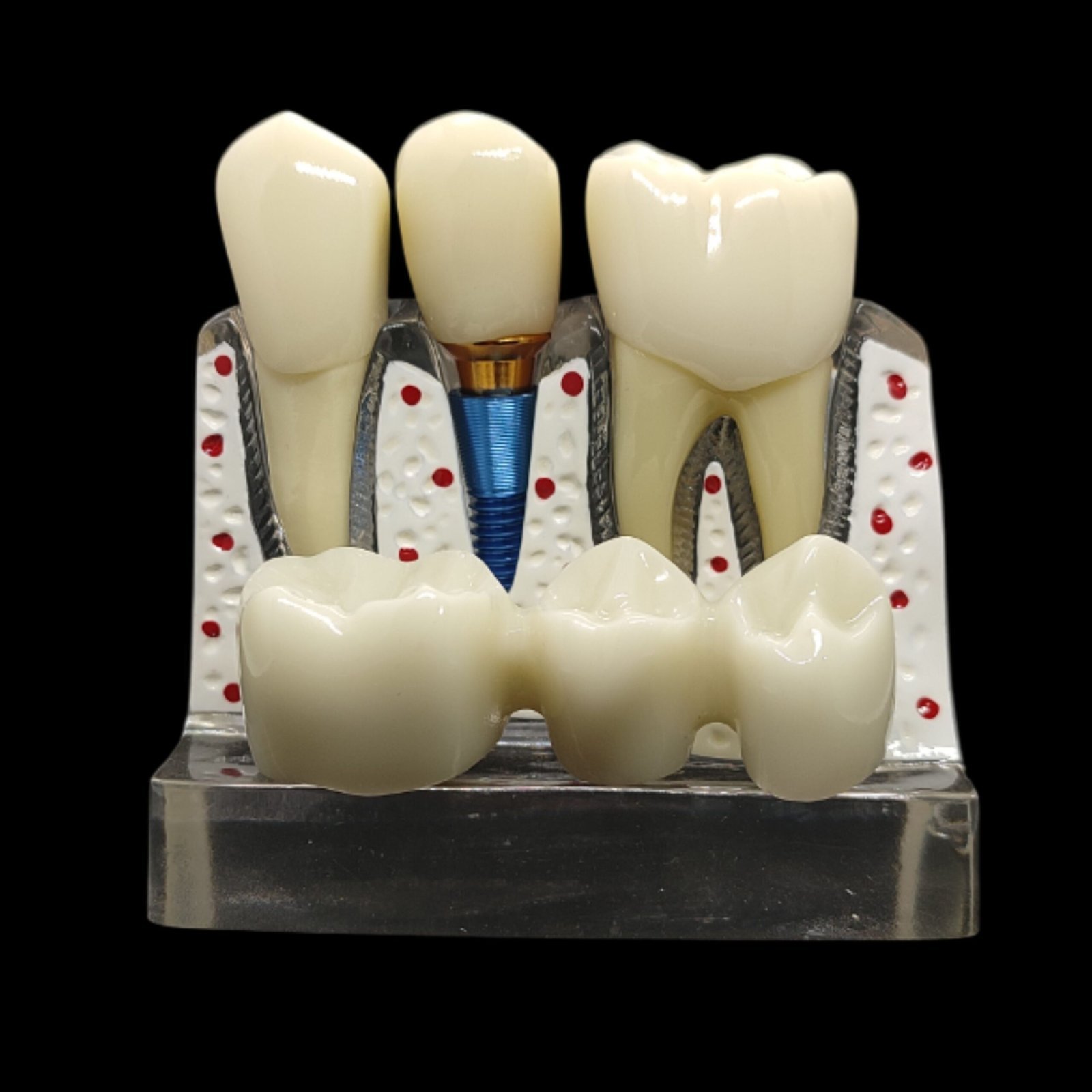 Implant Analysis Model Transparent Color