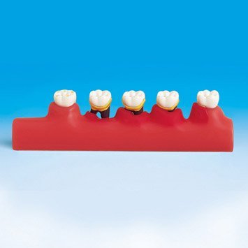 PERIODONTAL DISEASE MODEL - Image 3