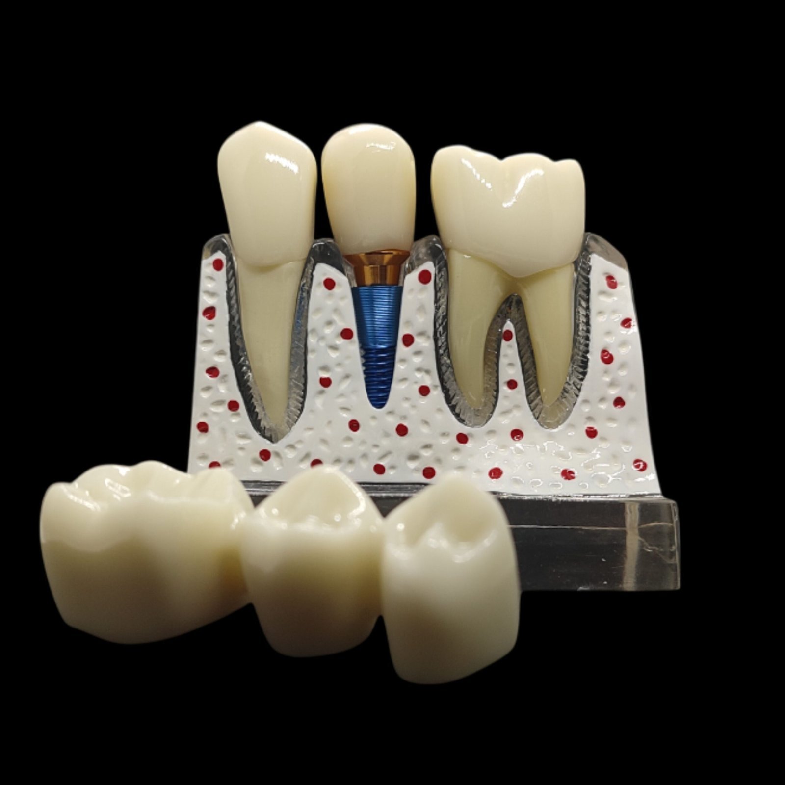 Implant Analysis Model Transparent Color - Image 3