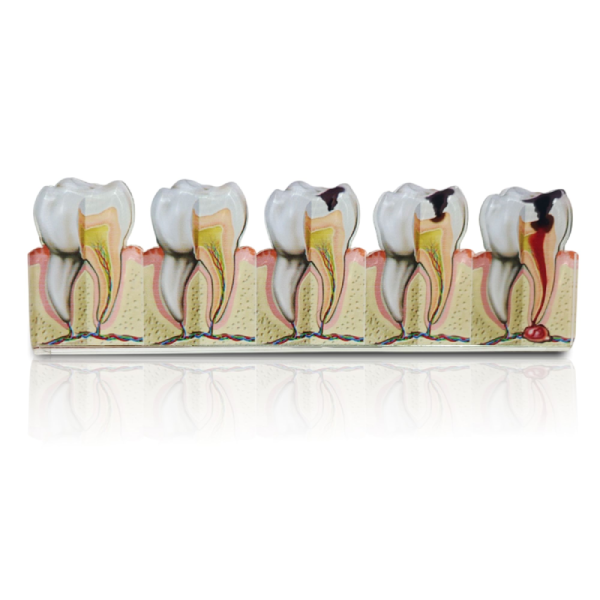 2D Advanced Tooth Decay Model - Enamel to Abscess Formation