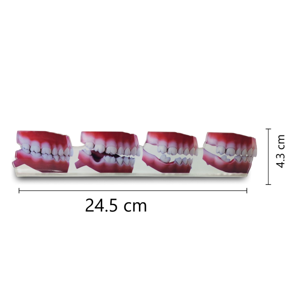 Dental 2D Model Ð Consequences of Missing Teeth Educational Model - Image 2