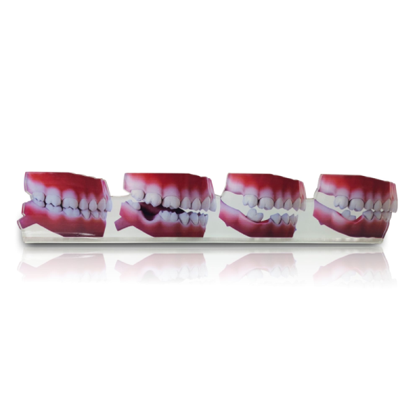 Dental 2D Model Ð Consequences of Missing Teeth Educational Model - Image 3