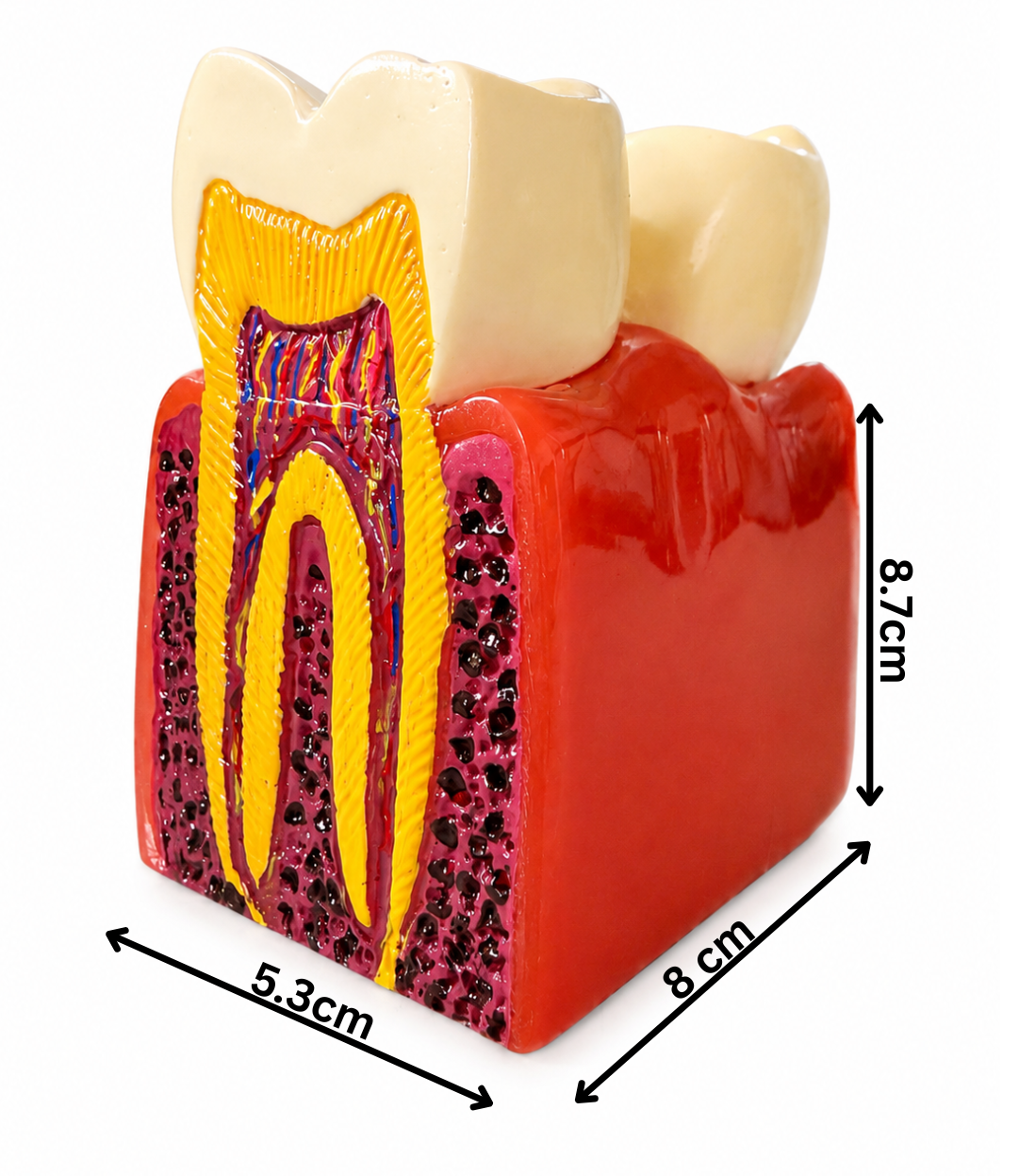 Tooth Decay Dental Model