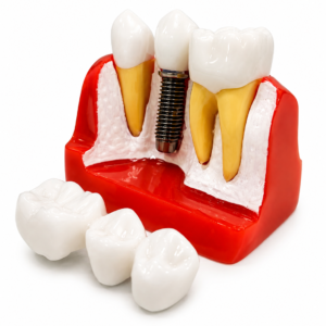 Three Tooth Implant Model
