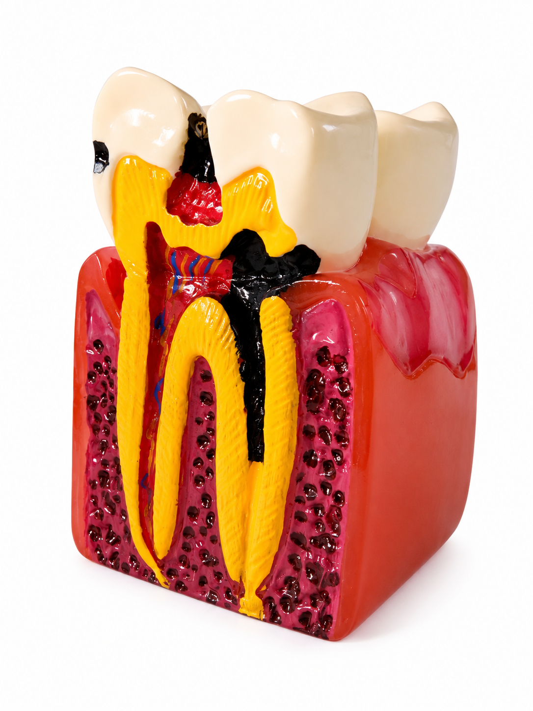 Tooth Decay Dental Model