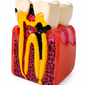 Tooth Decay Dental Model