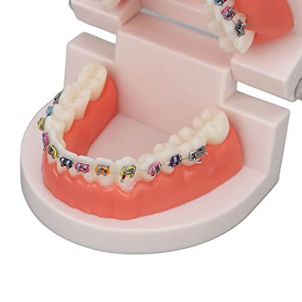 Patient Education Model With Orthodontic Brackets