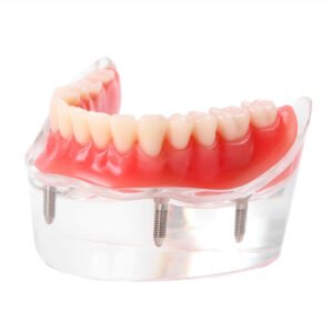 Over Denture Model With 4 Implant