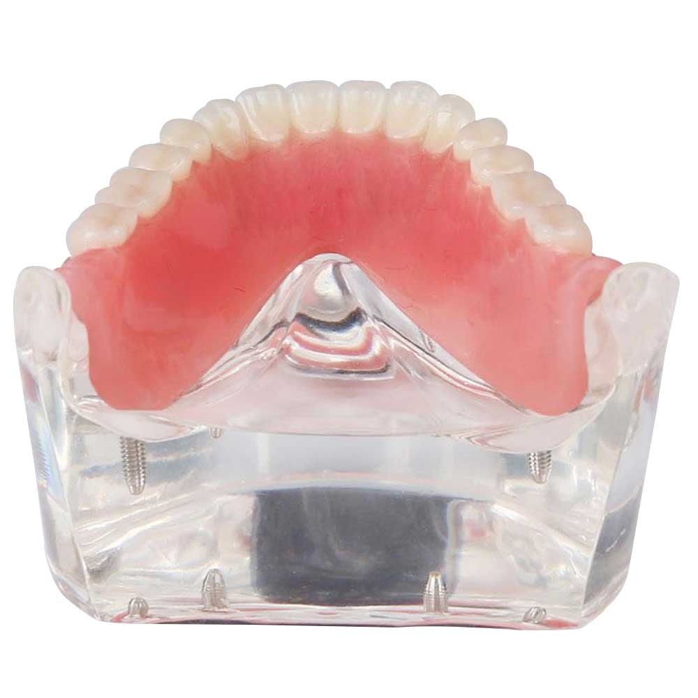 Over Denture Model With 4 Implant