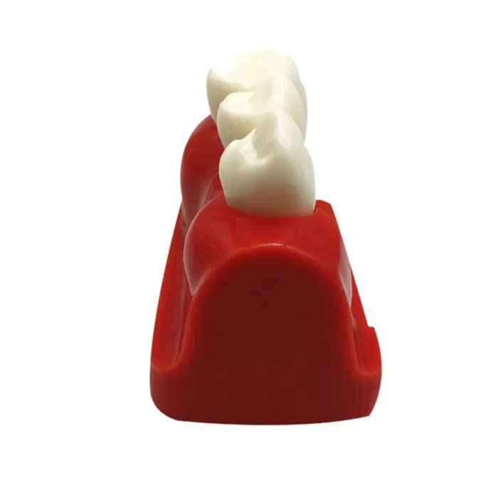 Three Tooth Implant Model