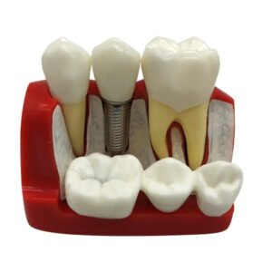 Three Tooth Implant Model