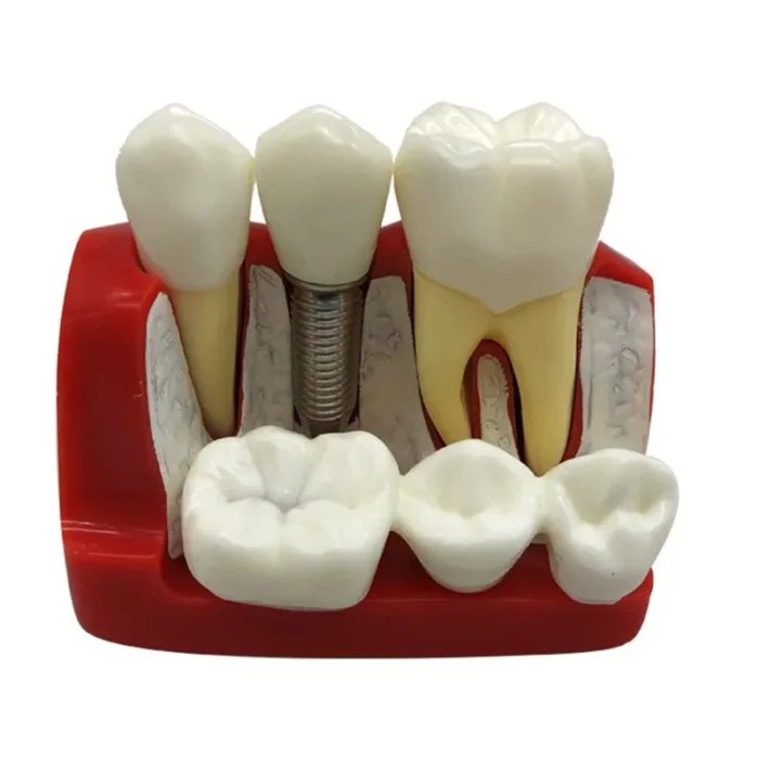 Three Tooth Implant Model