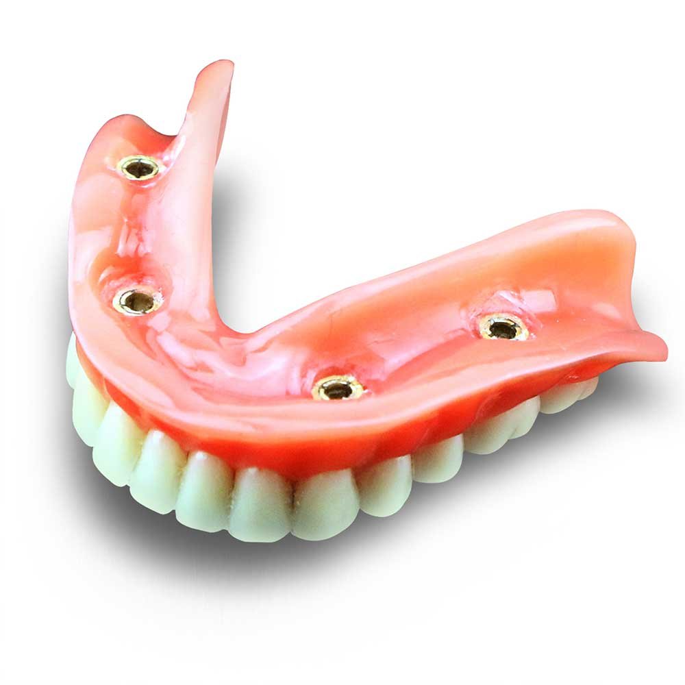 Over Denture Model With 4 Implant