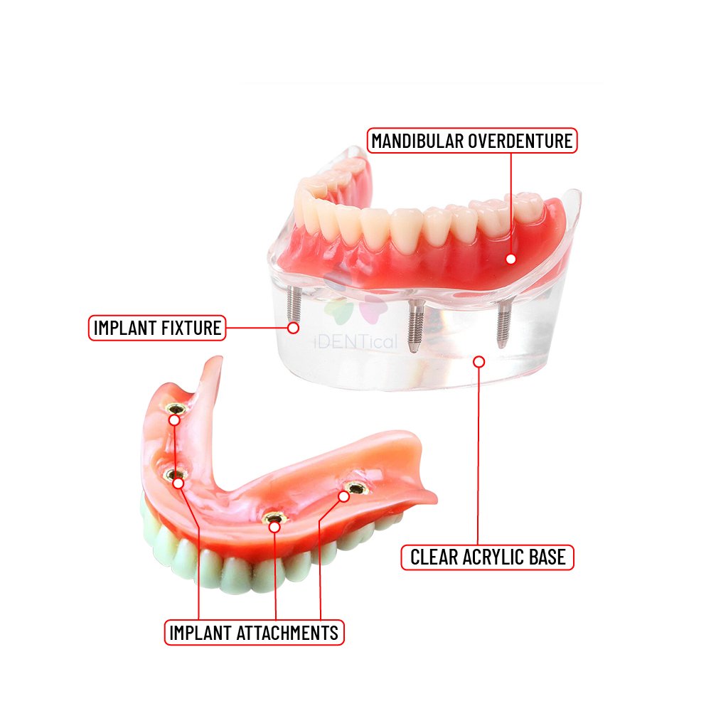Over Denture Model With 4 Implant