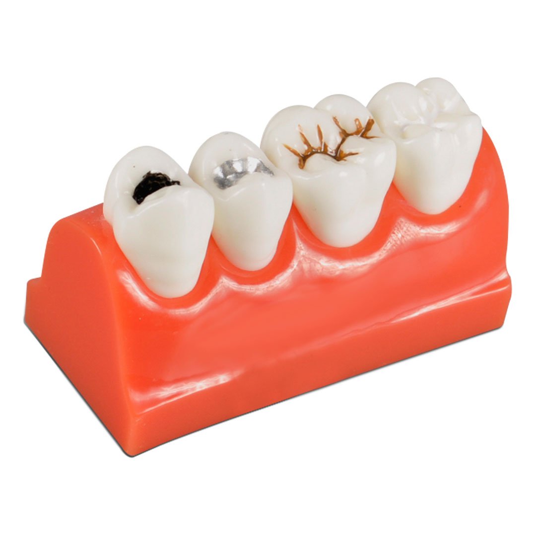 Dental Caries Model | Tooth Decay & Demonstration Model