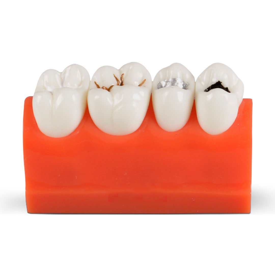 Dental Caries Model | Tooth Decay & Demonstration Model