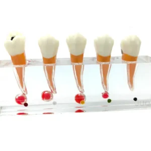 Endodontic Treatment Stages Model