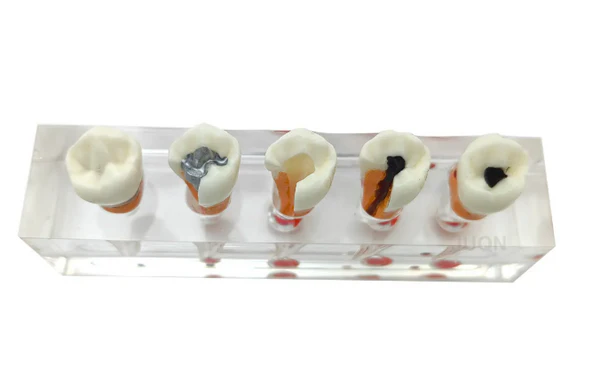 Endodontic Treatment Stages Model