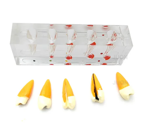 Endodontic Treatment Stages Model