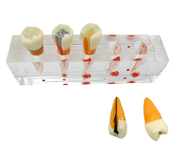 Endodontic Treatment Stages Model