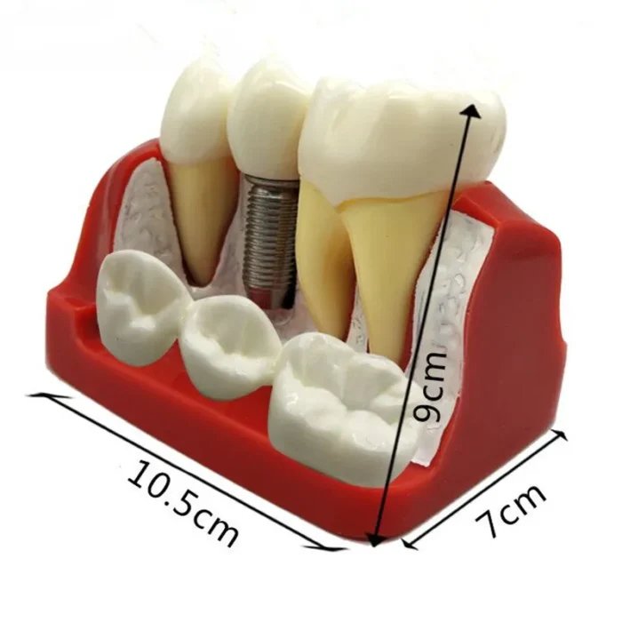 Three Tooth Implant Model