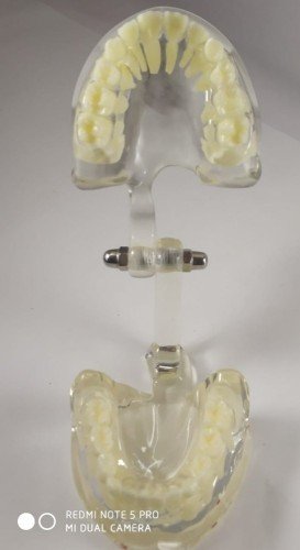 Pediatric Dental Model Age 7 – Mixed Dentition Educational Model