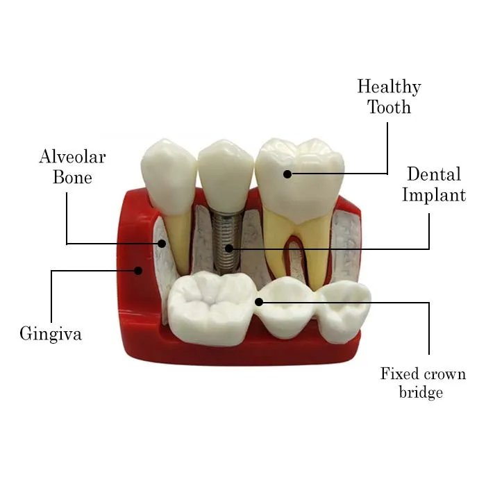 Three Tooth Implant Model