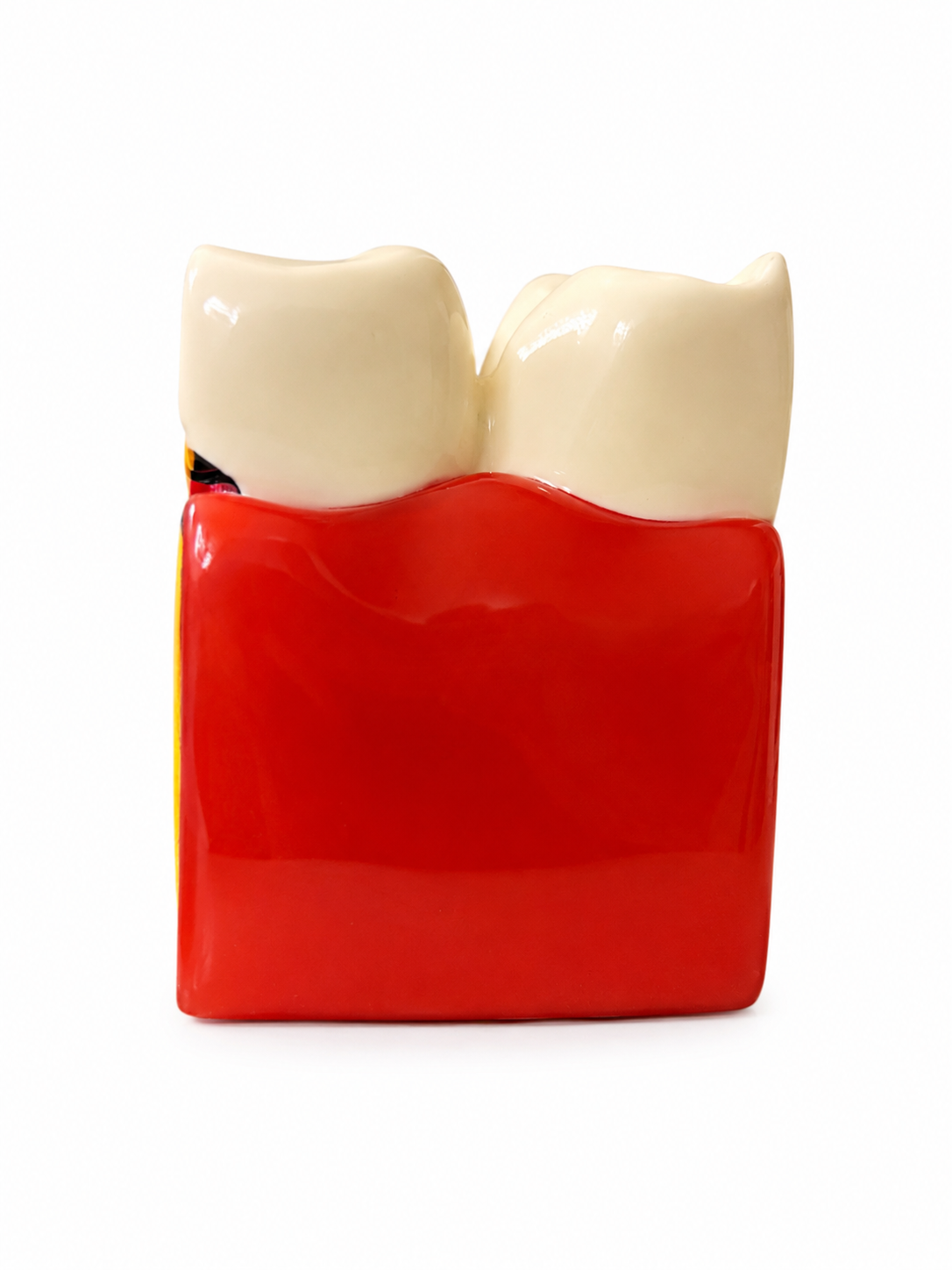 Tooth Decay Dental Model