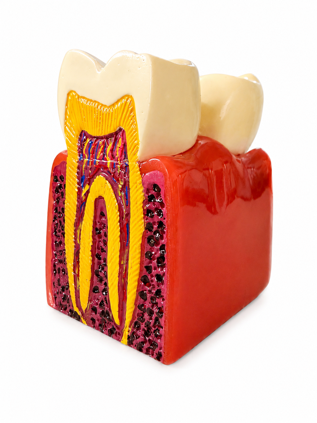 Tooth Decay Dental Model