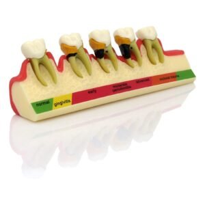 Periodontal Disease Model