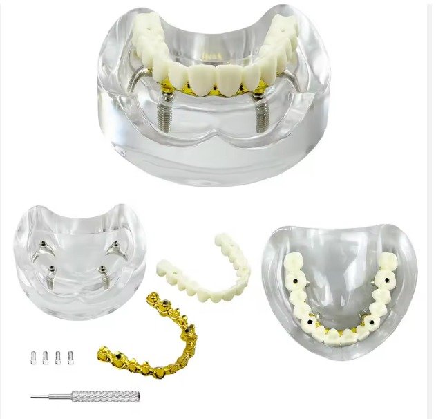 All-on-4 Paulo Malo Implant Model