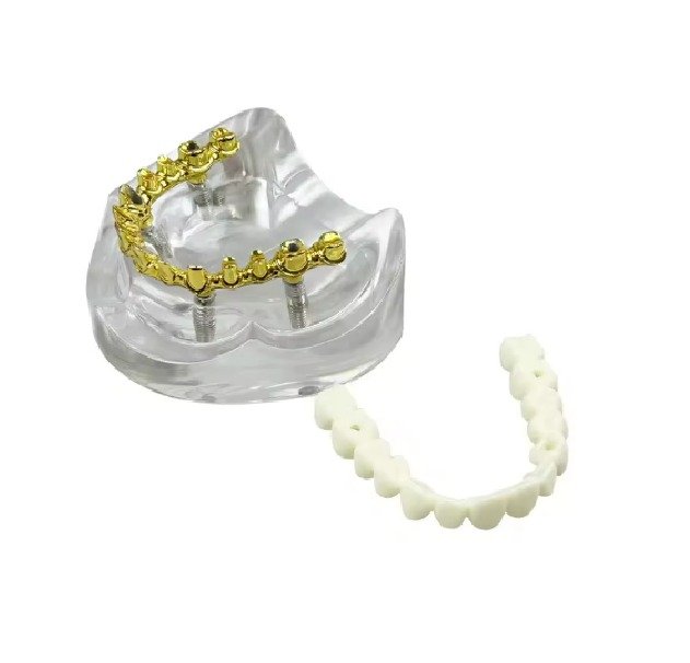 All-on-4 Paulo Malo Implant Model