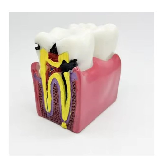 Tooth Decay